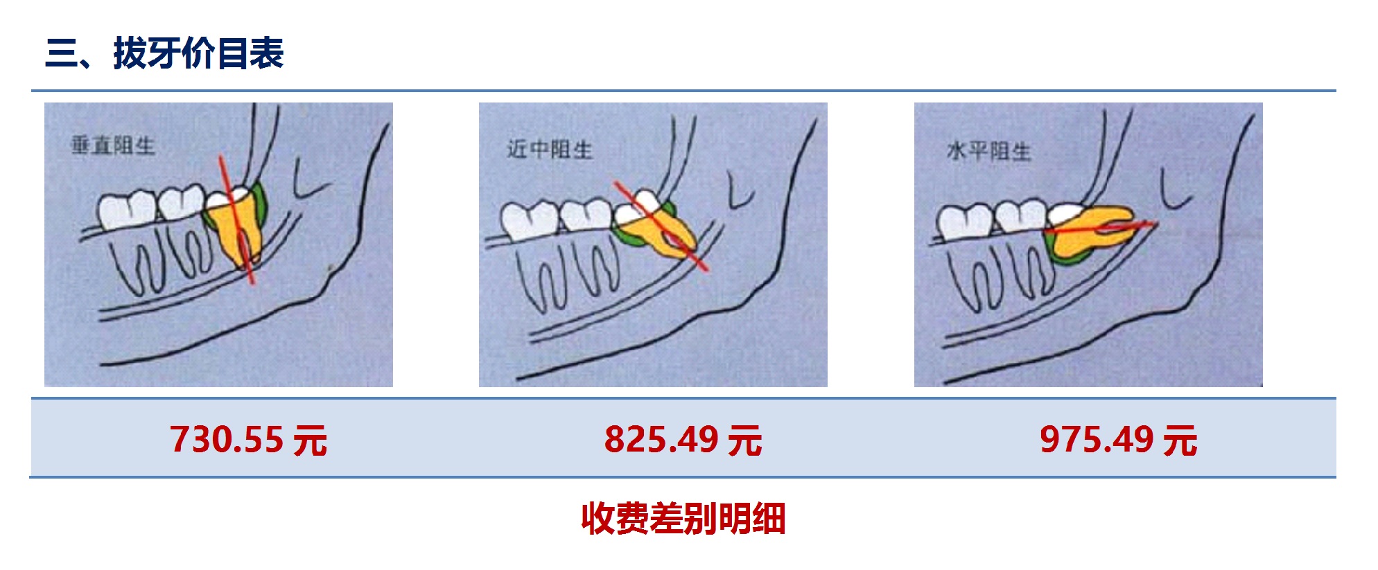 拔智齒多少錢?——拔牙收費有了明白賬-陳國昆主治醫師-愛問醫生