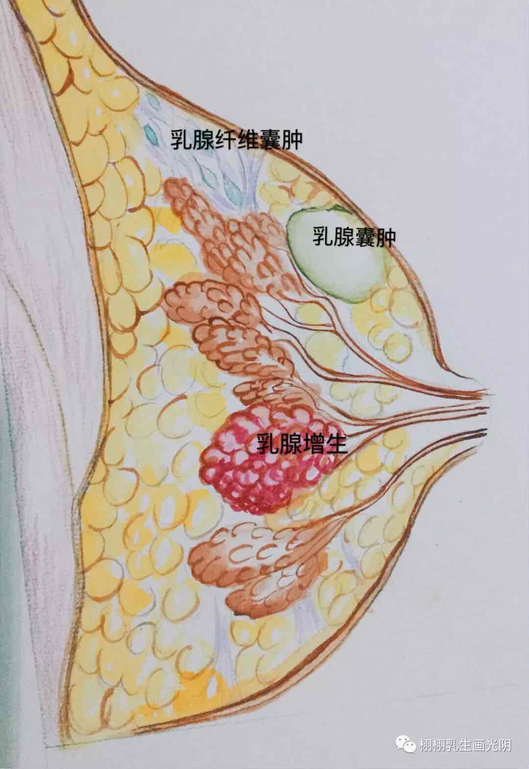 乳房主要由兩部分組成:乳房的腺體及包繞乳腺腺體的脂肪囊.