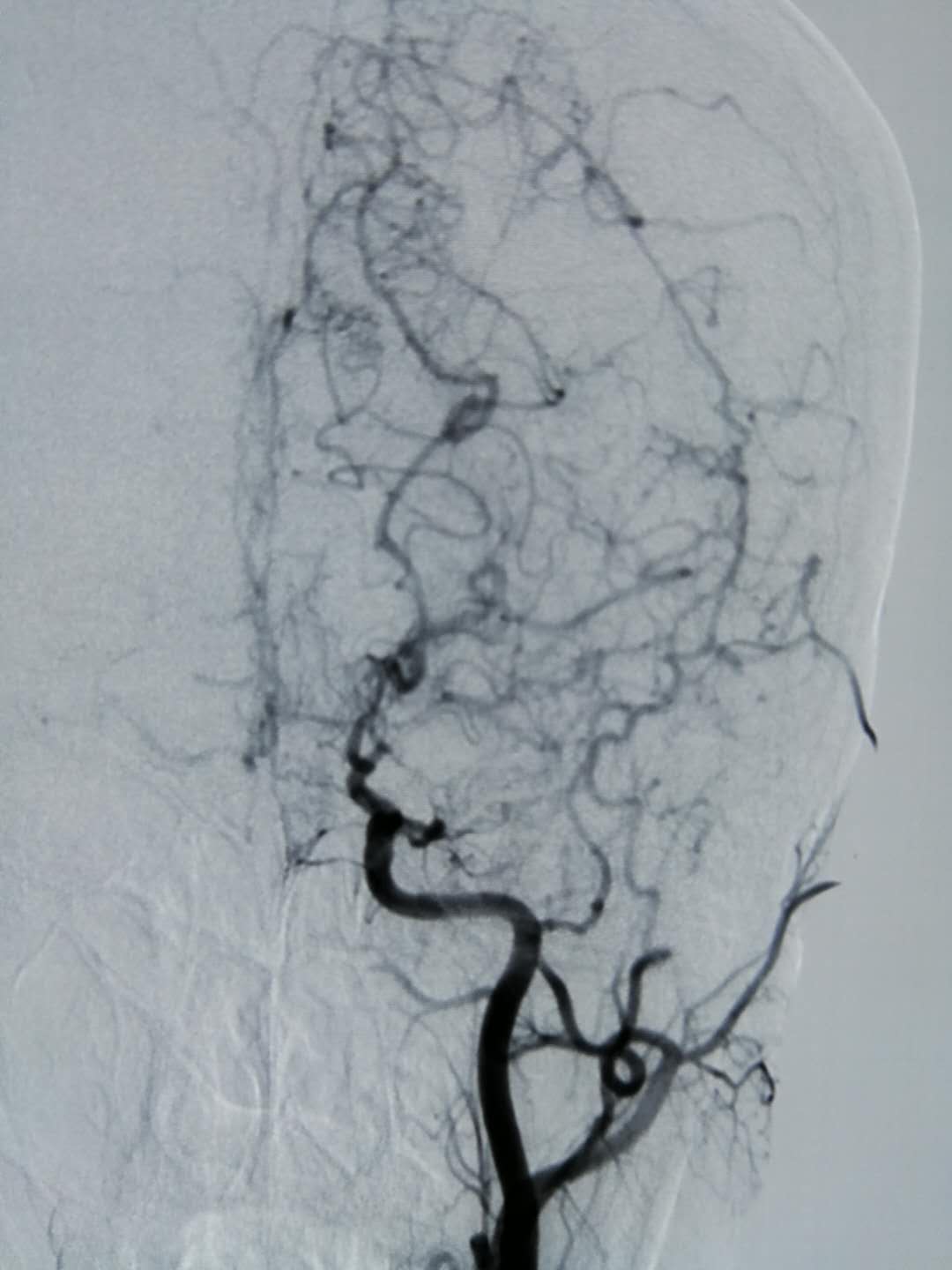 医生解答:成人烟雾病初期,不手术不吃药,养着能好吗?