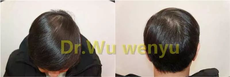 案例分析 植发一年头发长成什么样 医生说 39健康网