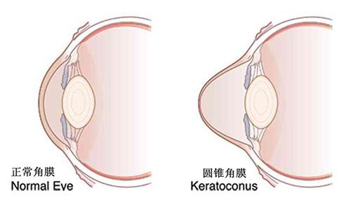患了圆锥角膜,该怎么治疗呢?
