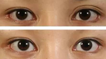 修复:采用重睑修复术进行修复改善,术后上睑下垂矫正了,黑眼球暴露度