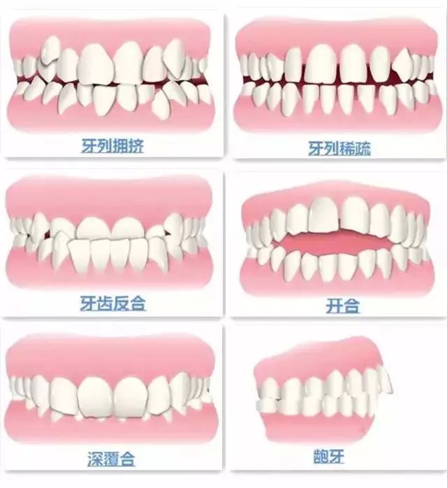 牙齿矫正 牙齿矫正前中后期 你所想了解的问题解答 马晓蓬副主任医师 爱问医生