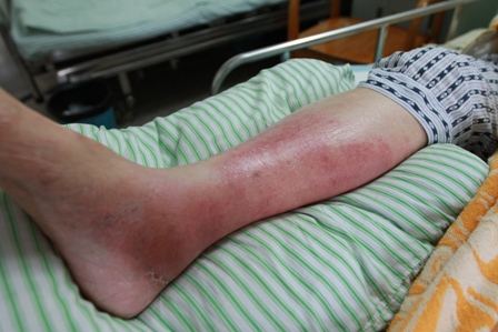 小小脚气痒健康大问题