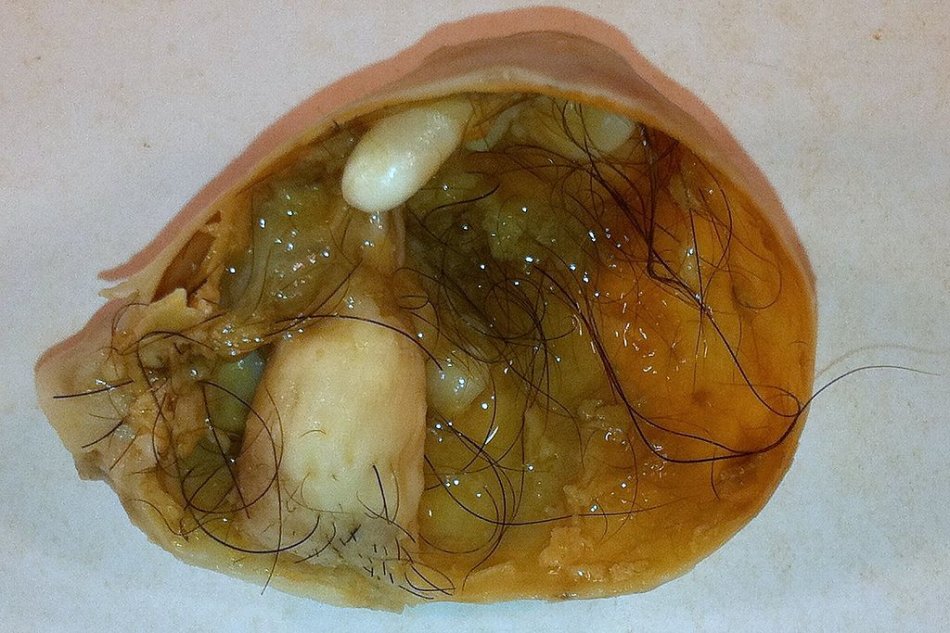 崎胎瘤图片