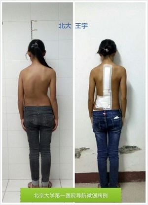 宾川12岁贫困少女脊柱侧弯,爱心为她撑起一片天