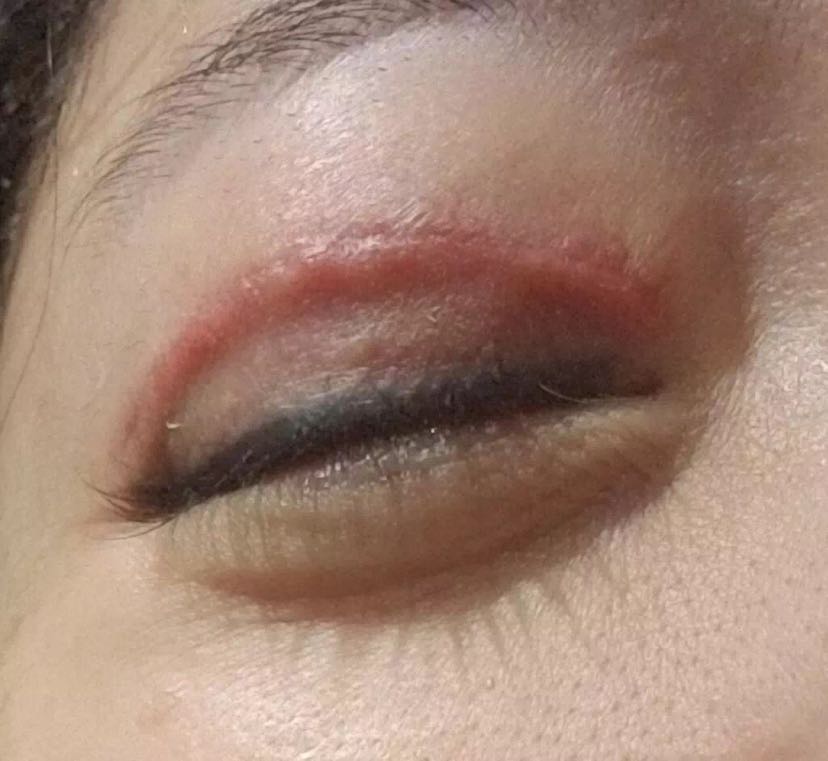 双眼皮手术后为什么一定要肿呢