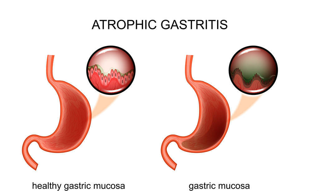 有没有幽门螺杆菌,做一下这个测试就知道,四种胃病都是因为它!