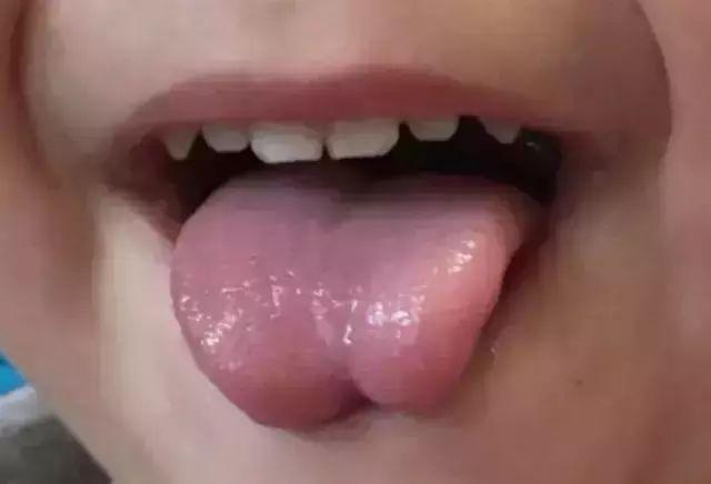 很多人会以为舌系带短就是舌头短,这是错误的认识,舌系带俗称舌筋