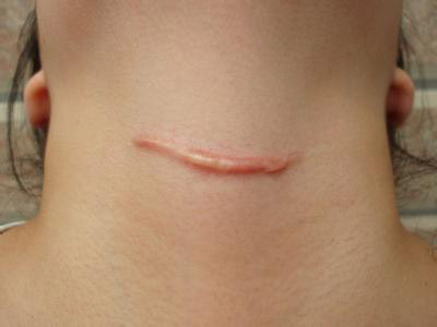 疤痕增生越来越大是什么原因