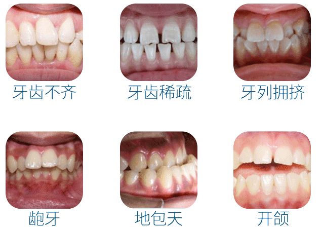 人口多少牙齿_蜗牛有多少颗牙齿图片(2)