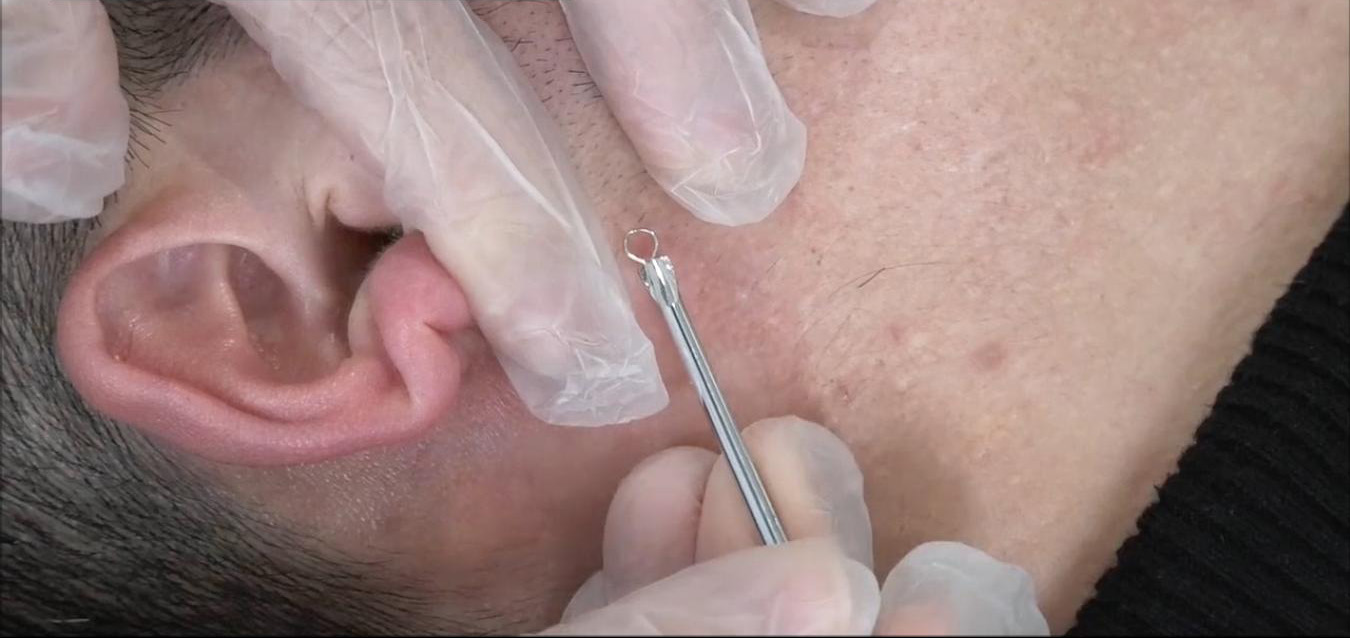 针清痘痘的利与弊今日一次性分析清楚