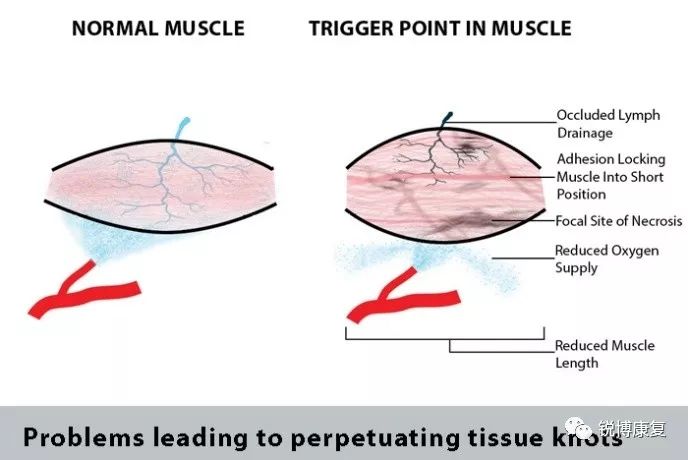跑后牵出窜麻感肌肉结节惹得祸