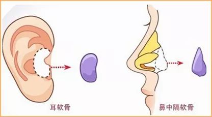 耳软骨隆鼻主要是以自己身上的软骨组织进行隆鼻,软骨隆鼻的优点是