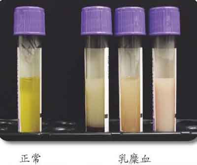 高甘油三酯患者的血清就像掺入了牛奶,严重者呈乳糜状,称乳糜血