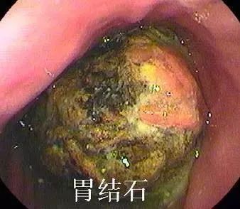 大爷很瘦,捂着肚子,疼的很厉害.