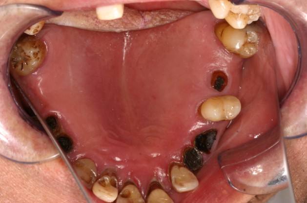 拔牙适应症,你遇到过吗?-王俞方-爱问医生