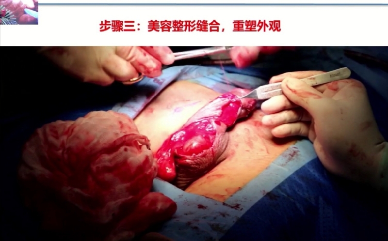 (图三,尿道下裂术后腹侧皮肤缺损修复实图)l