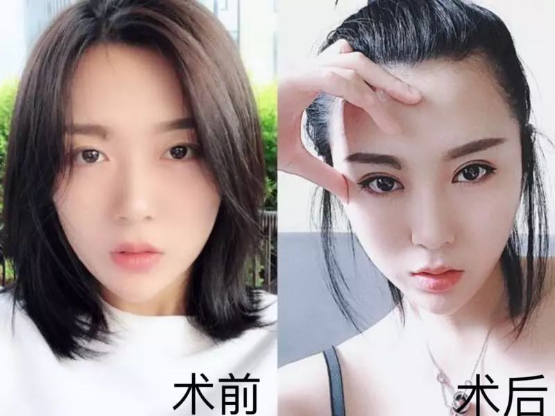 双眼皮比单眼皮好在哪里?(附案例)