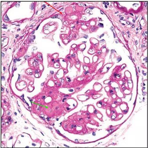 膜性肾病,3种方法可治疗