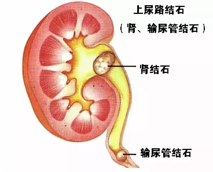 肾窦区结石图解图片