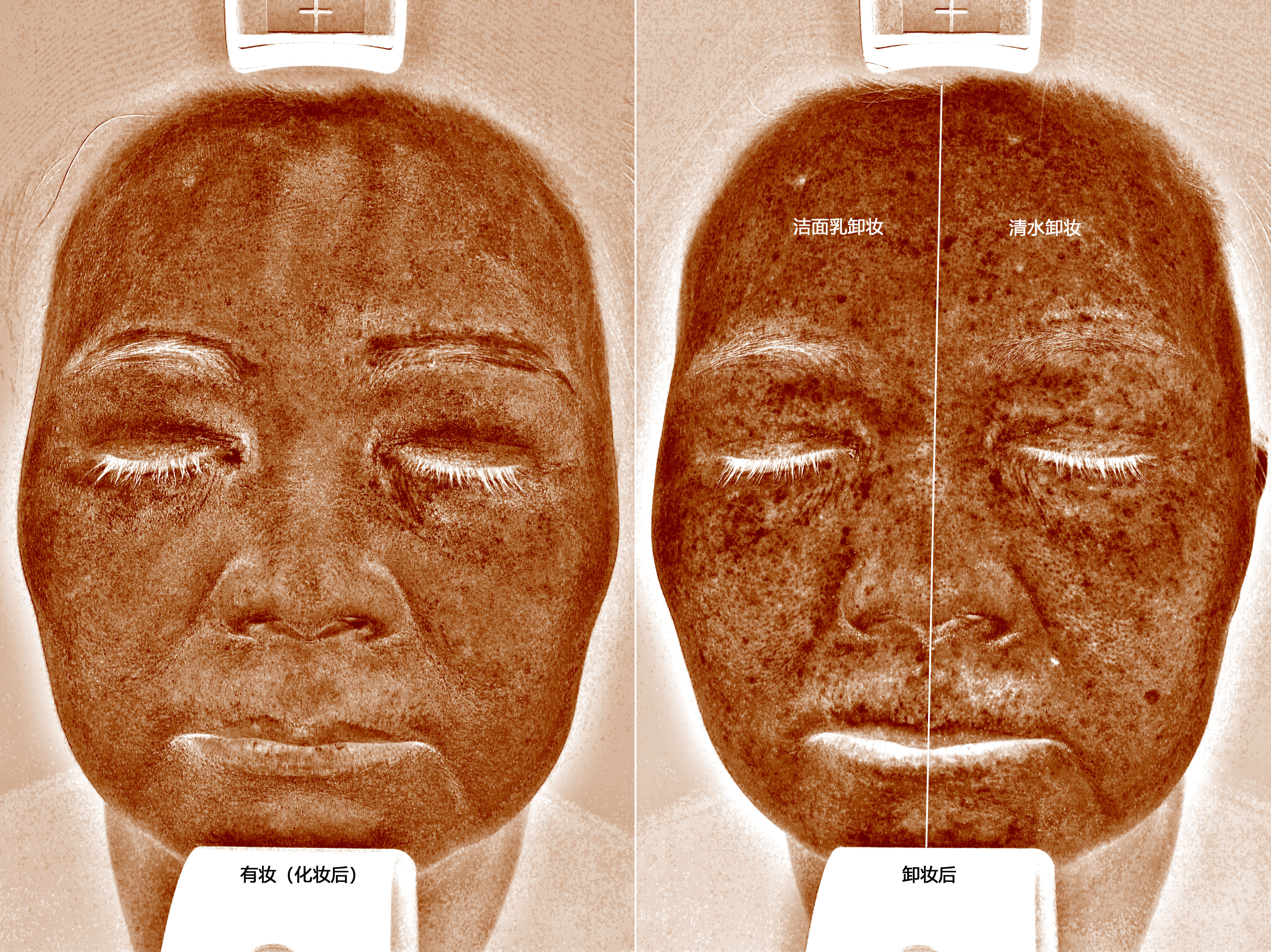 visia皮肤检测棕色斑图片