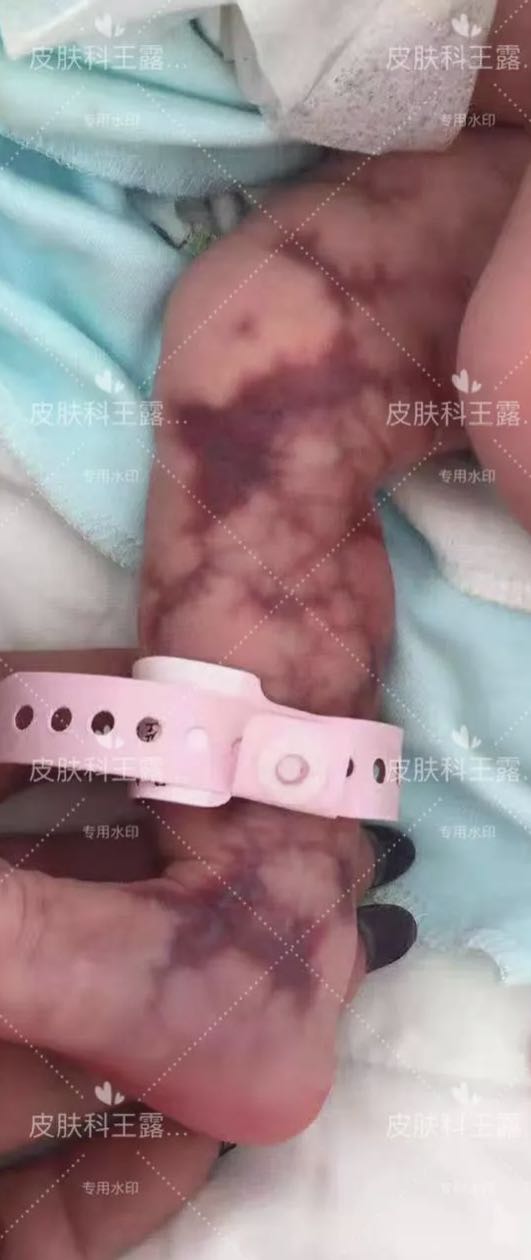 先天性毛细血管扩张性大理石样皮肤_王露_副主任医师_爱问健康