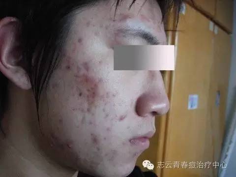 面部痤瘡常見的八大臨床症狀