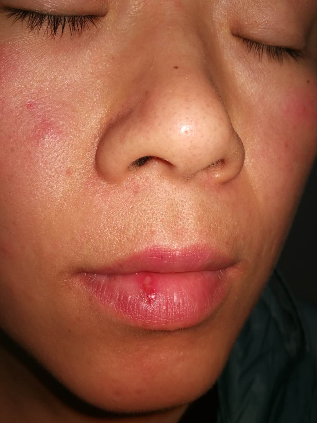 湿疹/皮炎合并感染