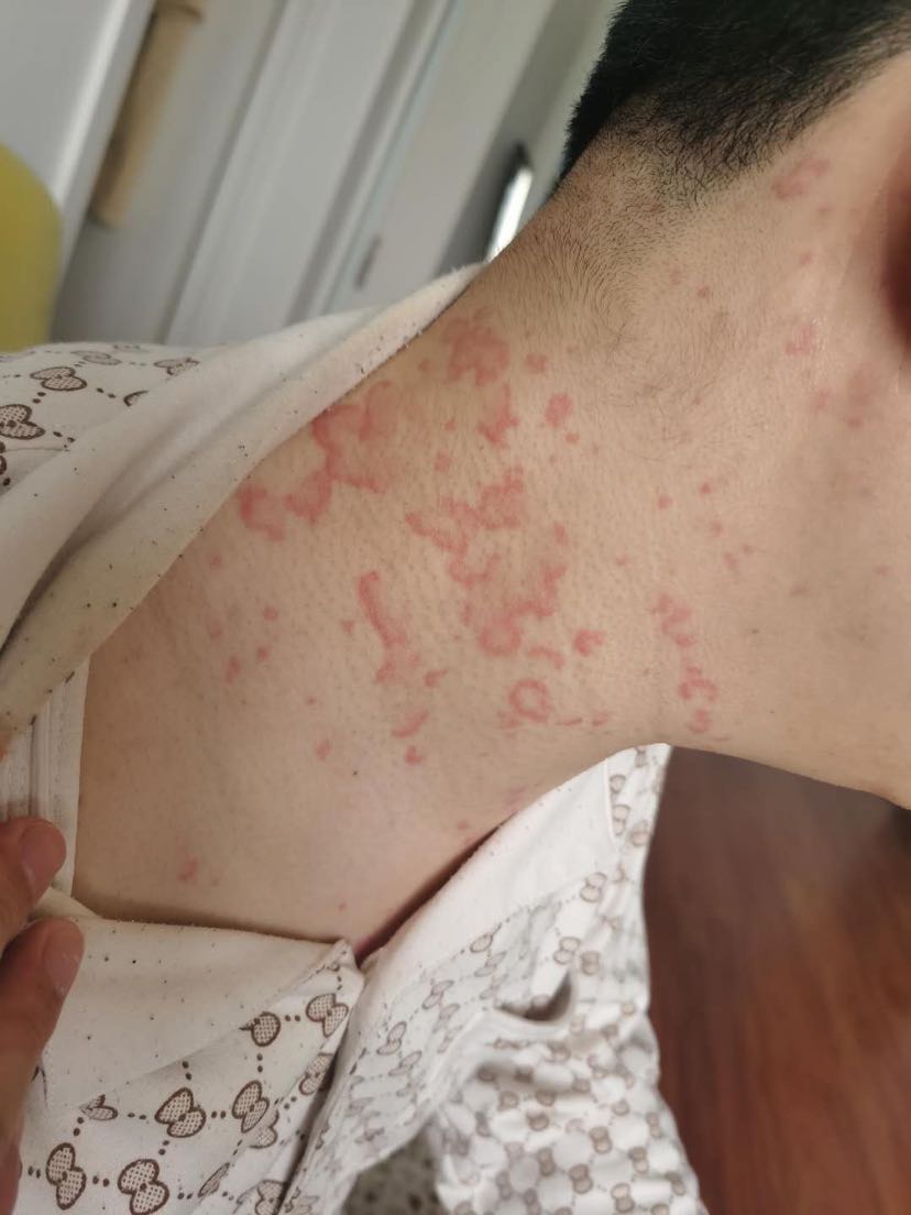 急性荨麻疹可能会出现喉头水肿出现窒息死亡建议尽快来急诊就诊