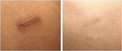 做鼻整形,取肋软骨很恐怖?