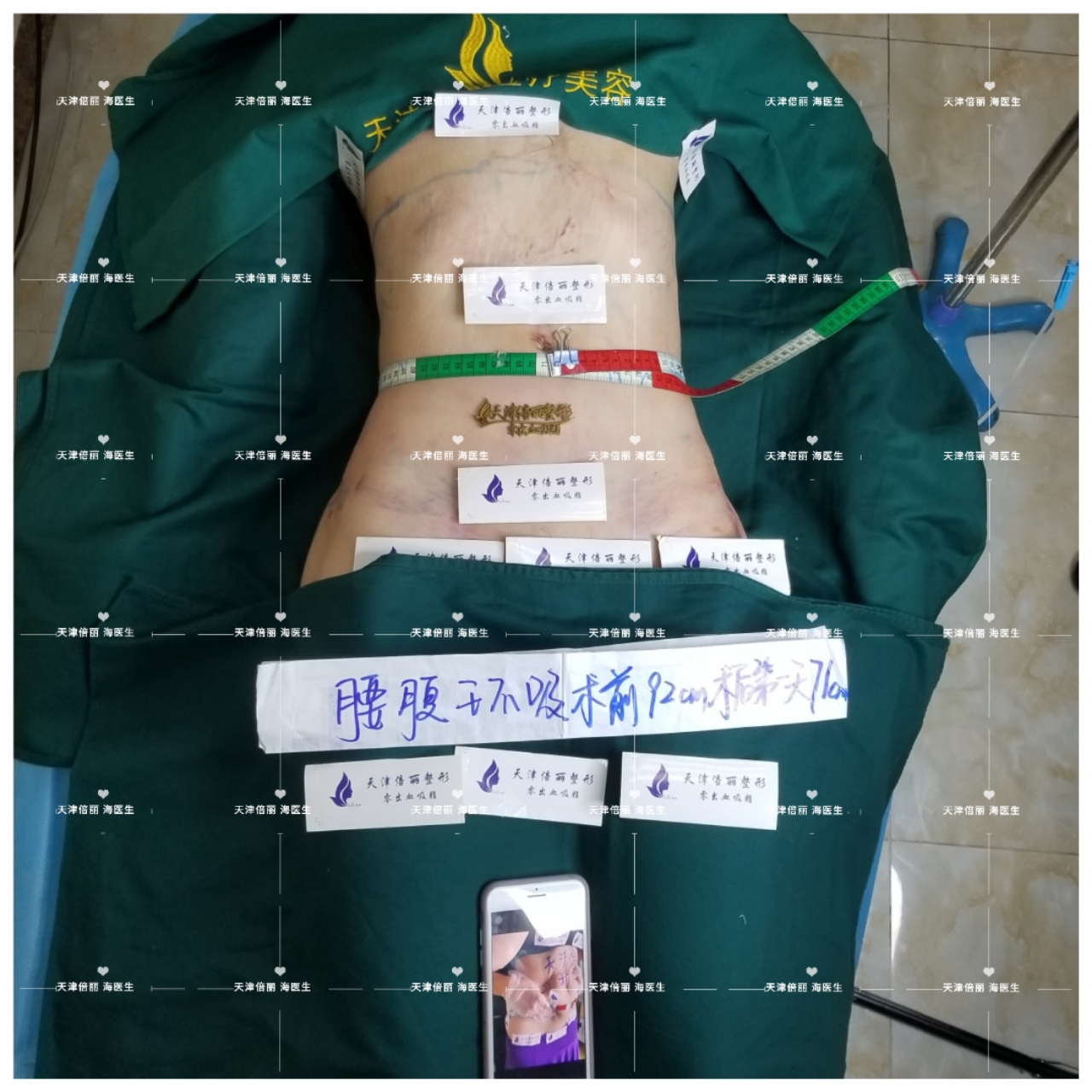 腰腹吸脂第一天什么样?