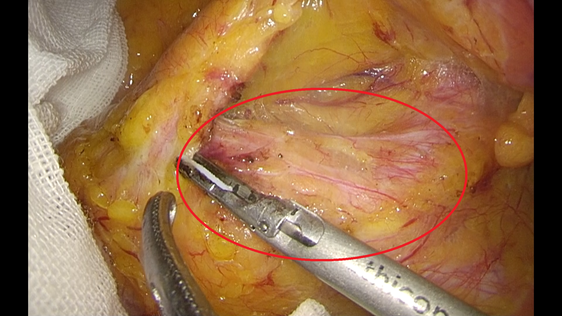 从"干撸枪没子弹"谈谈腹腔镜直肠癌根治术中的神经保护