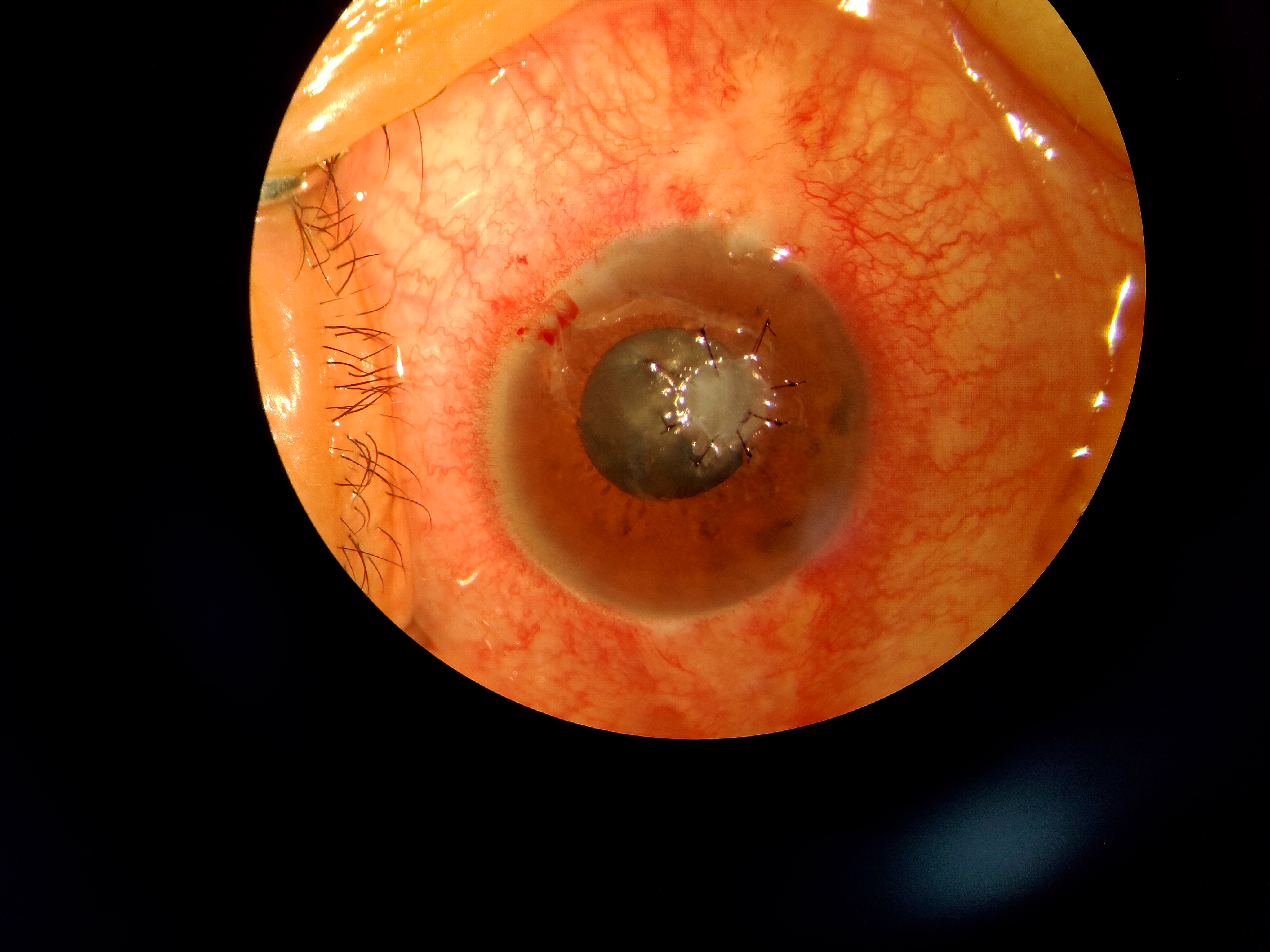 羊膜移植在眼表治疗中的作用