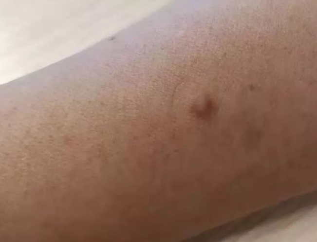 皮肤纤维瘤也属于皮肤软组织肿瘤的一种,其实非常常见,不管大人,小孩