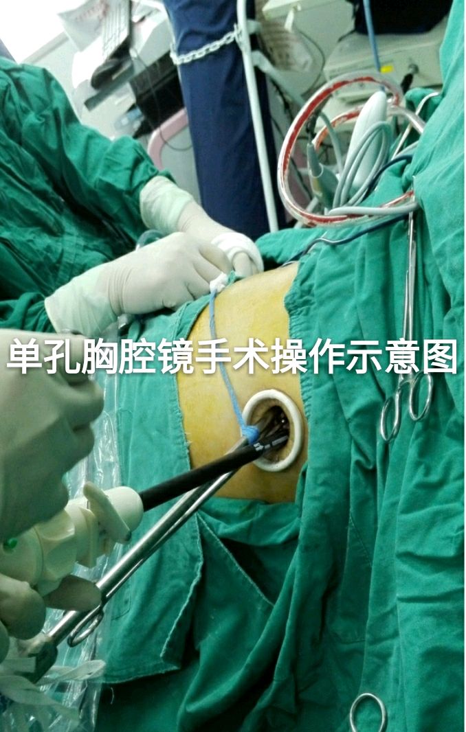 3厘米单孔胸腔镜切口是如何取出大肿物的