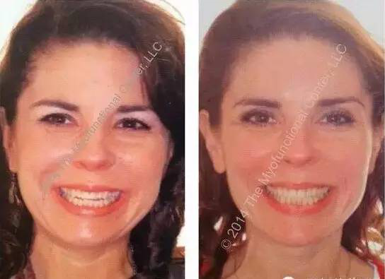 张着嘴巴呼吸会变丑