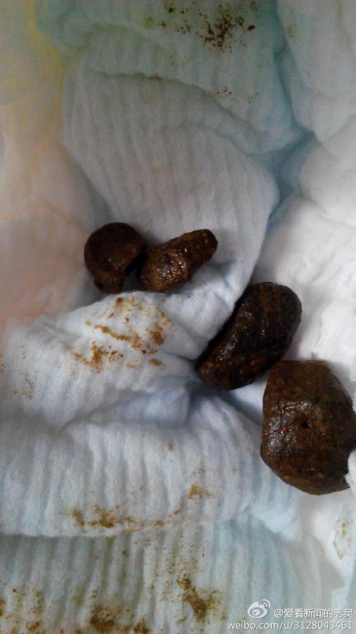 6个月了,女宝,母乳喂养,目前大便干结,如图!我该如何改善?谢谢求指导!