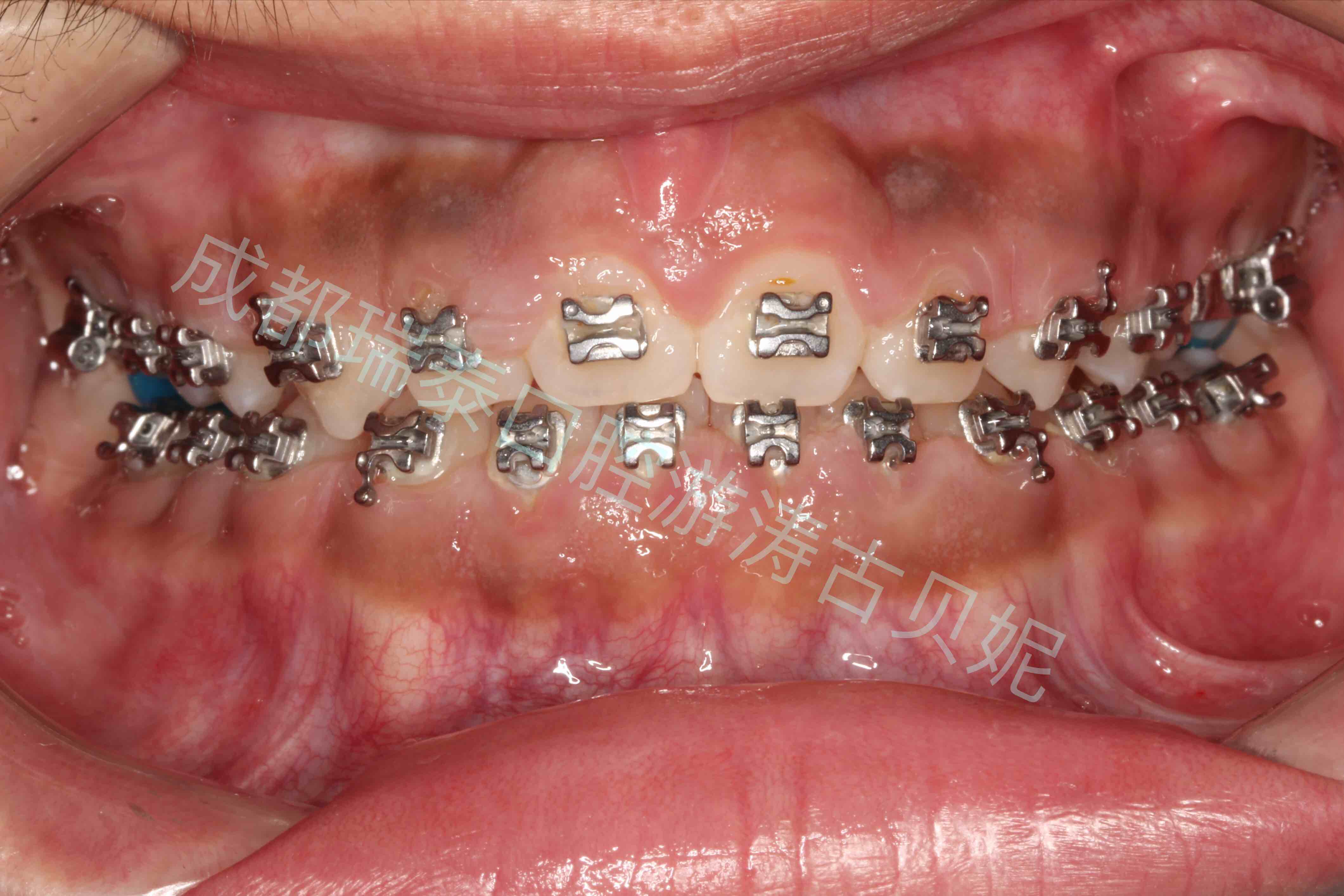 矫正过程中刷牙不当引起牙龈增生的手术实例