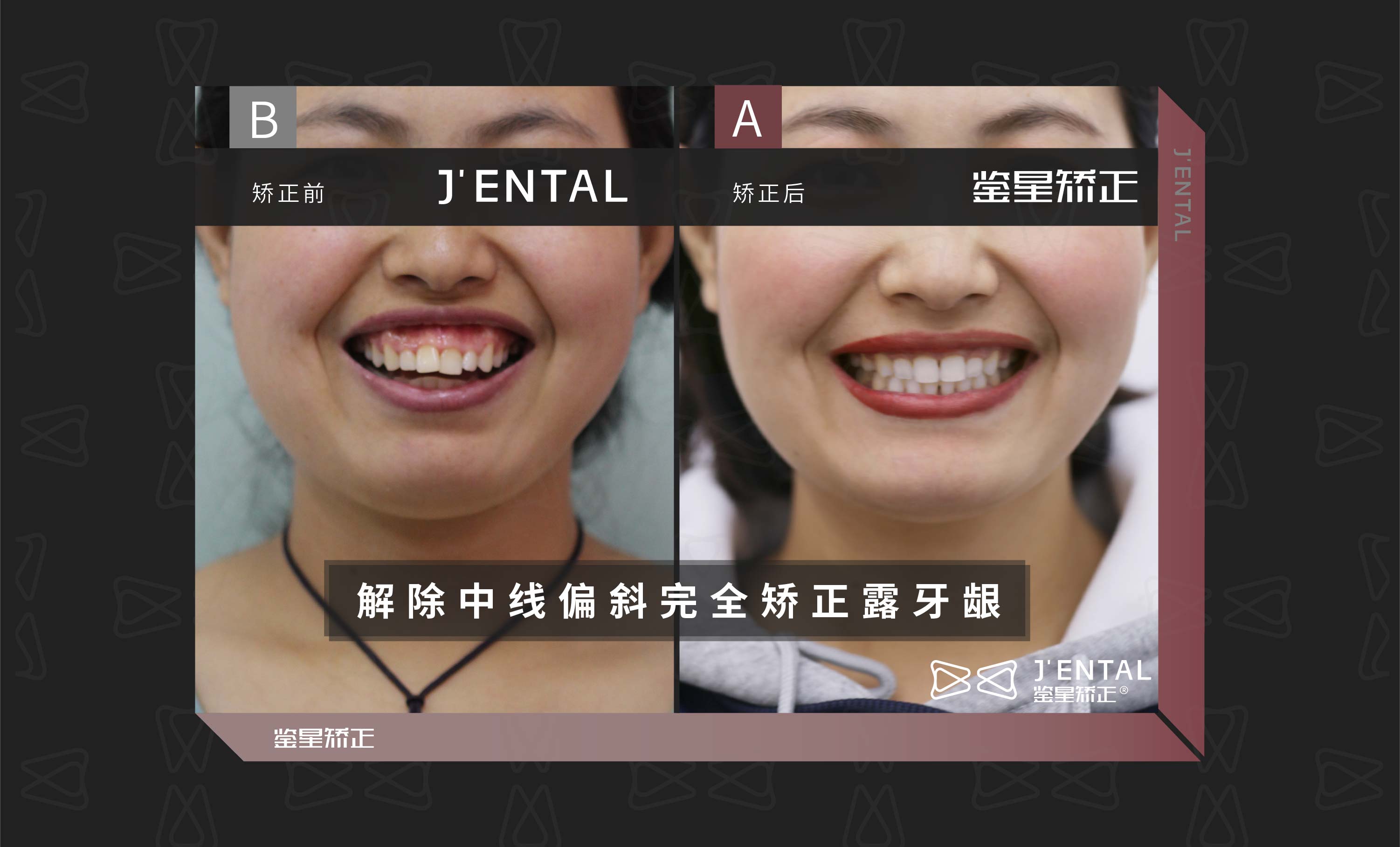 【牙齿矫正】4步分辨骨性龅牙和牙性龅牙 - 知乎
