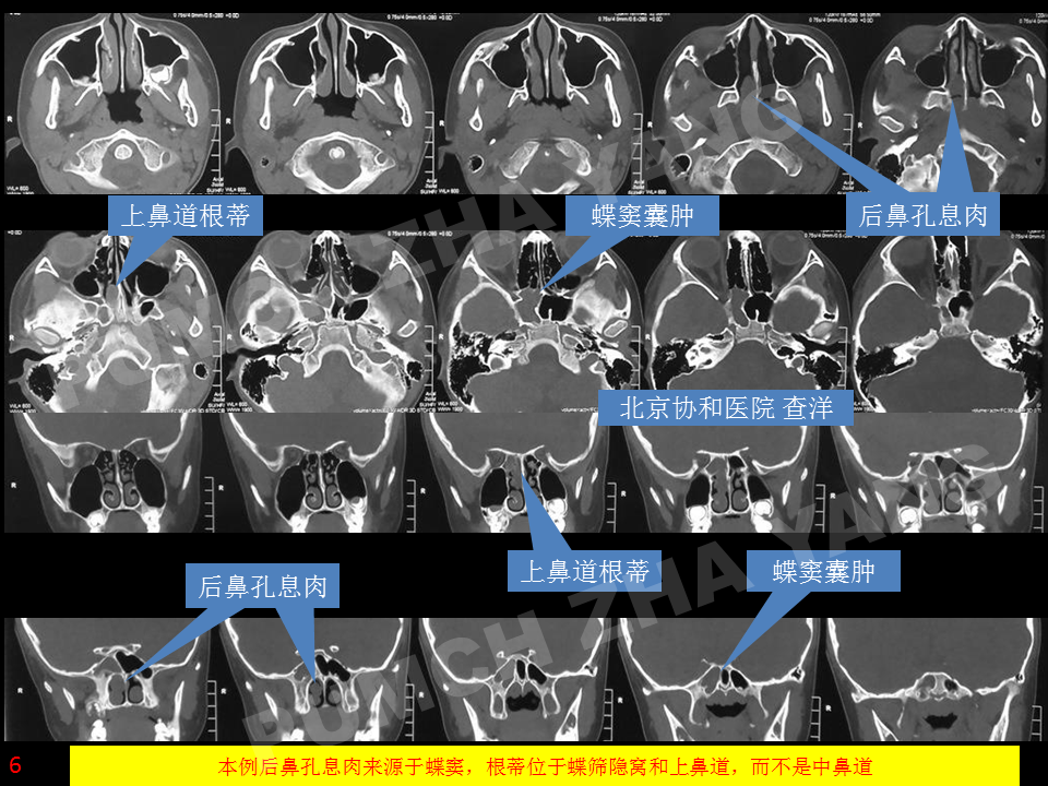 以青少年常見,需手術切除後鼻孔息肉和上頜竇內囊腫(典型病例可參考此