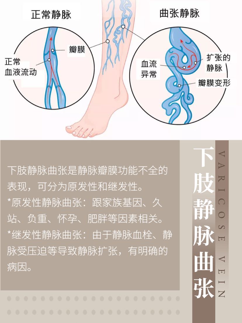 静脉瓣作用图片