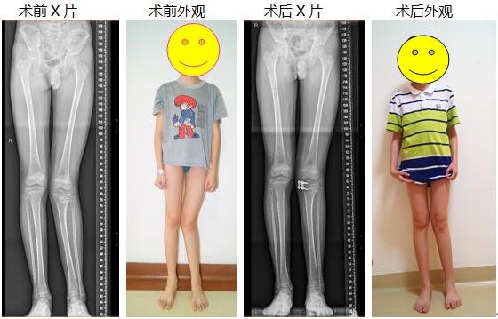 胫腓骨截骨 ilizarov外固定架治疗双侧严重膝内翻畸形88