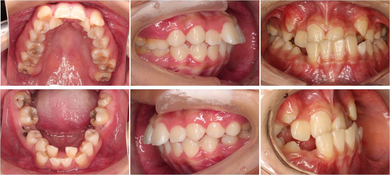 简单的说就是,有限的颌骨大小不足以整齐的排下那么多的牙了,牙齿要么