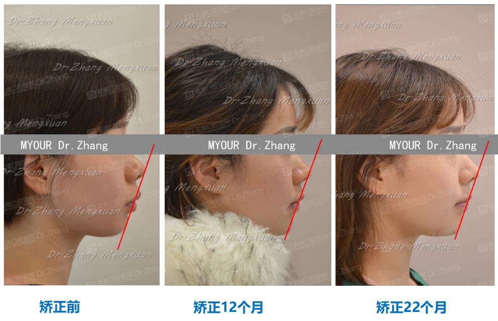 诊断:安氏ii类错颌畸形 骨性ii类 高角型 突面型矫治目标