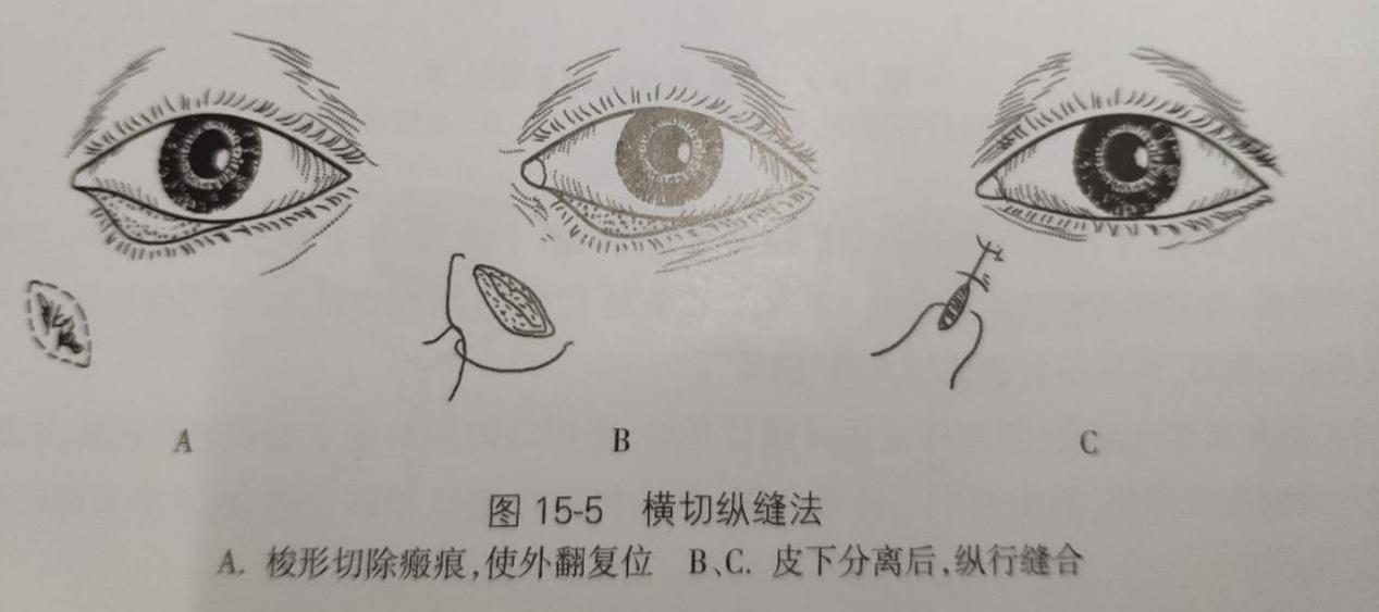 瘢痕性睑外翻的手术治疗