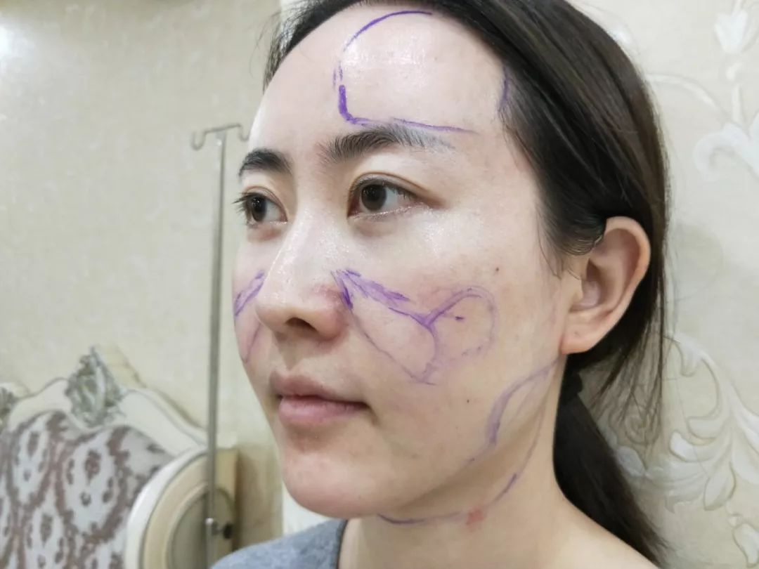 【案例】光纤溶脂瘦脸,告别肉肉脸