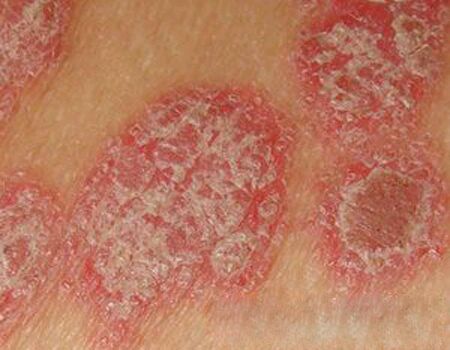 怎样自我判断银屑病