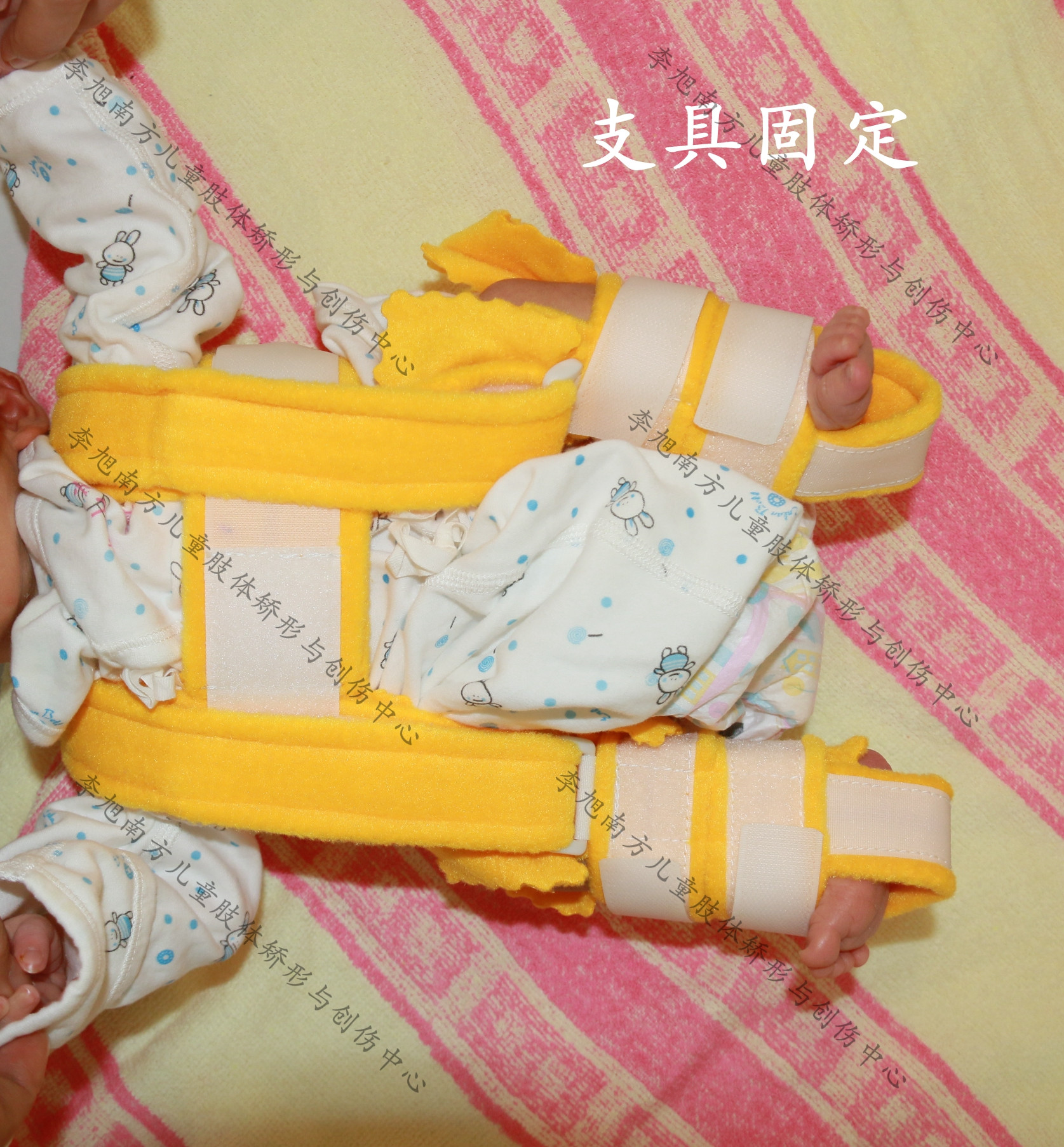 皮牵引的时间一般为4~6周,经x线显示有骨痂形成后,改为髋人字石膏或髋