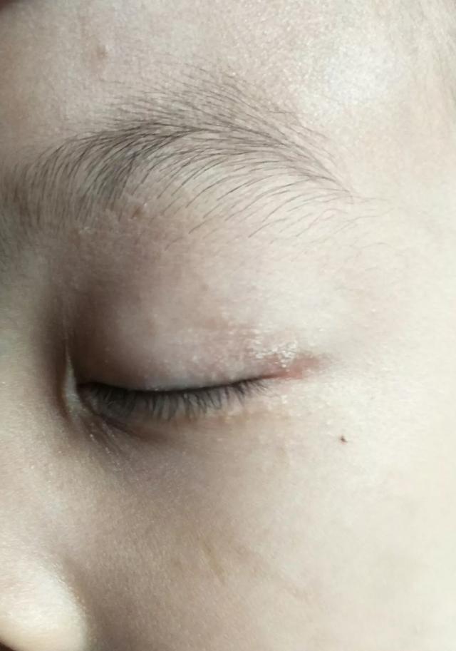 儿童眼睑皮炎症状图片图片